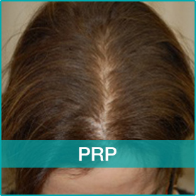 PRP Treatment